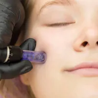 Kosmetikstudio ★ Schönheitssalon ★ microneedling in der nähe Mainz-Kastel  beauty by mel
