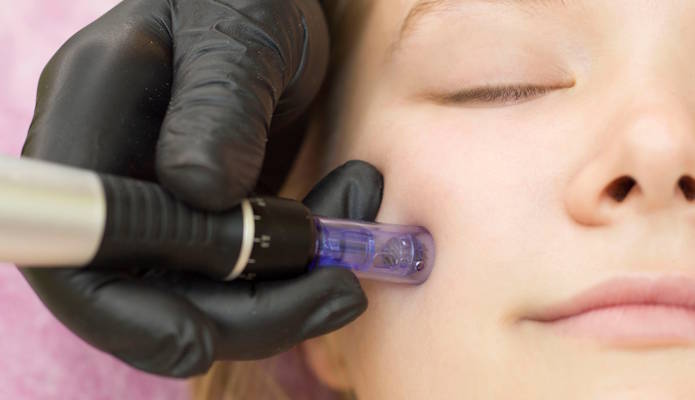 Microneedling Kosmetikstudio in der nähe Bischofsheim 
